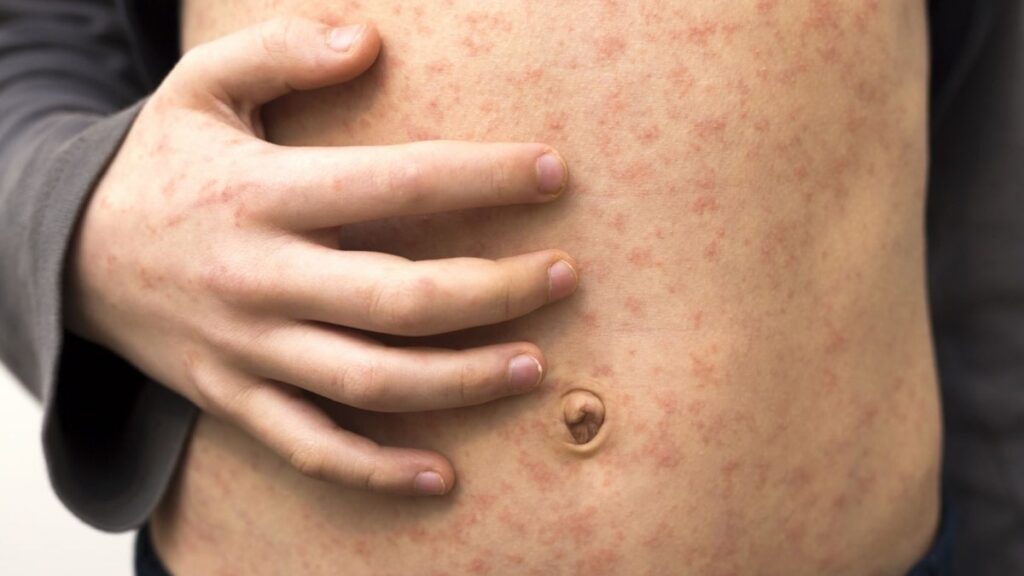 Another state confirms the case of measles with the infected child in the first year