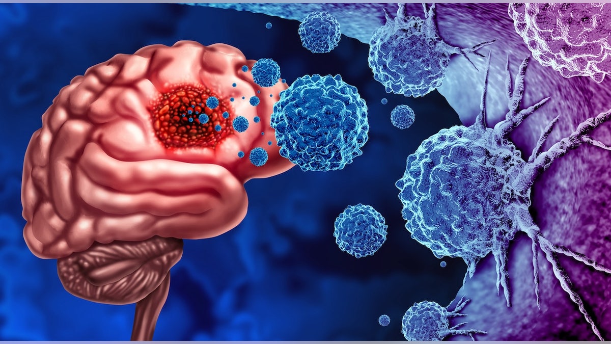 Tumor of glioma cancer