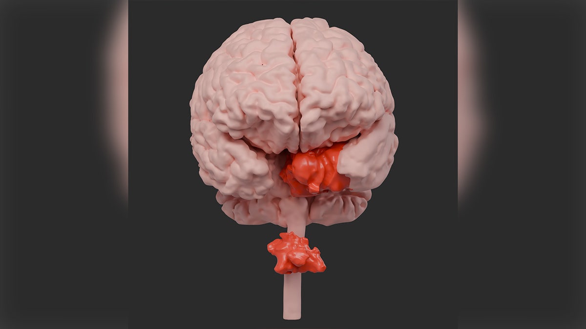 Illustration of the two spinal tumors of the patient