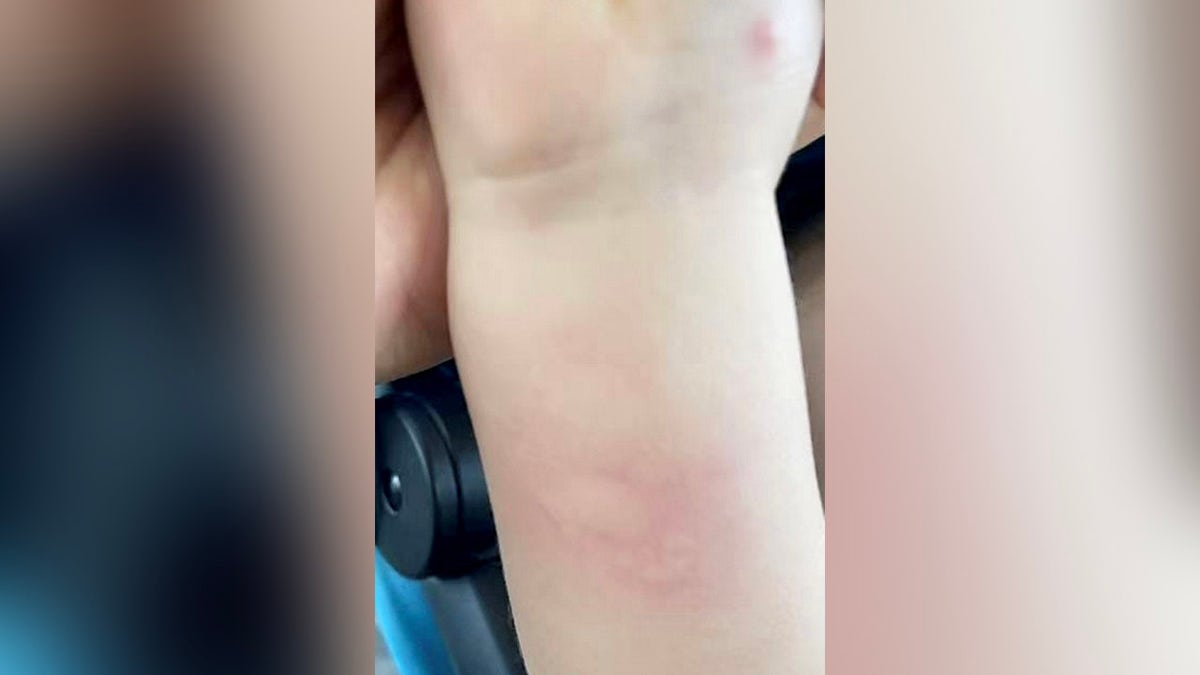Baby forearm (with zoom) showing rash along the forearm, chopped errors