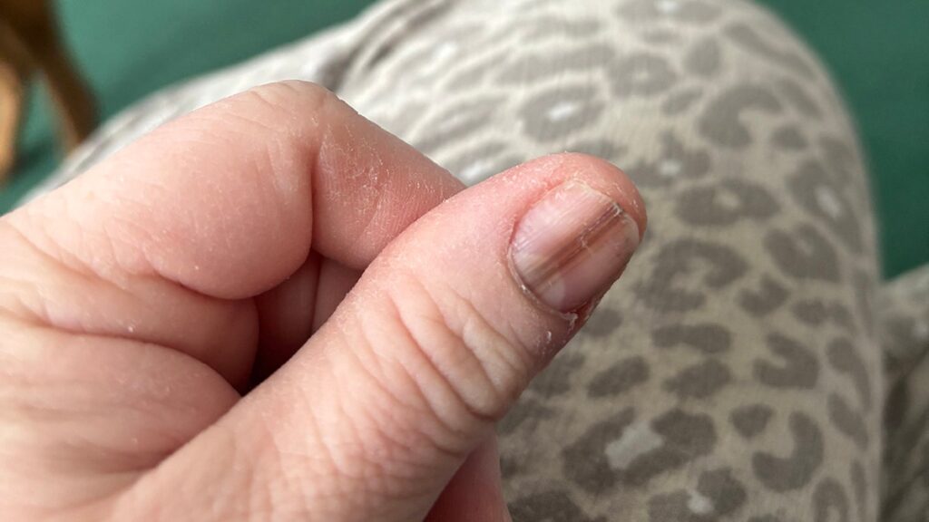 MOM credits Tiktok video for cancer diagnosis that saves life after discovering a strange nail brand