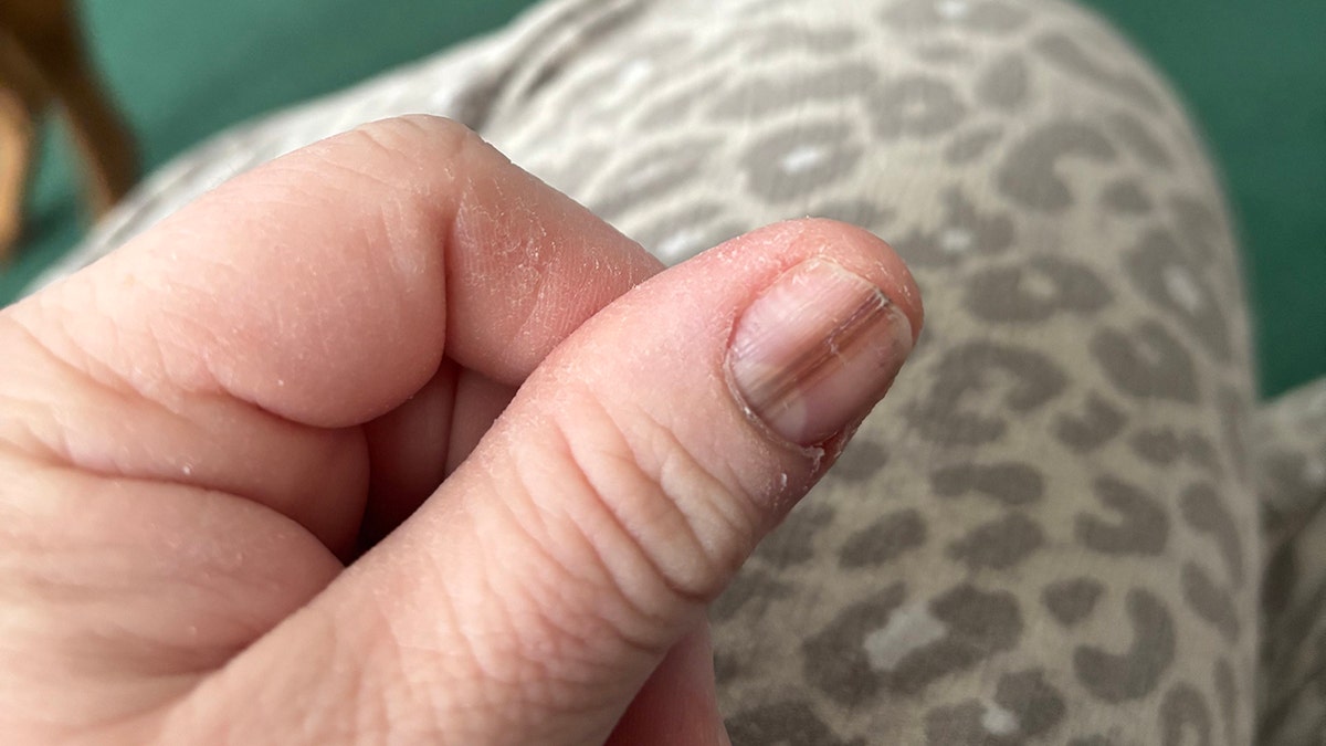 MOM credits Tiktok video for cancer diagnosis that saves life after discovering a strange nail brand