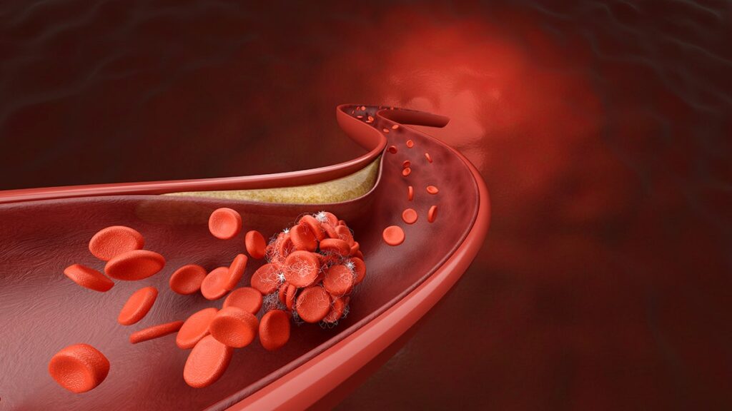 The AC ADVANCE allows doctors to “see” the dangerous blood clots formed
