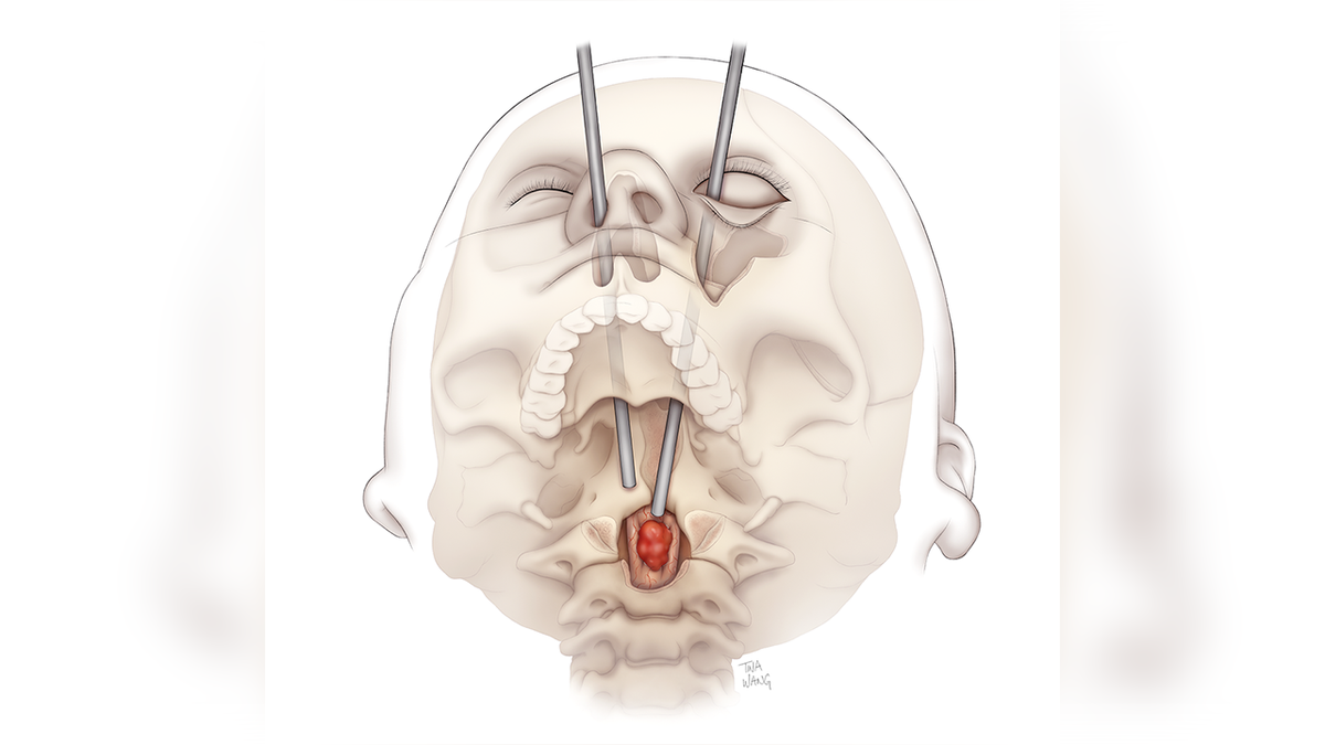 Illustration of the transorbital path to the tumors